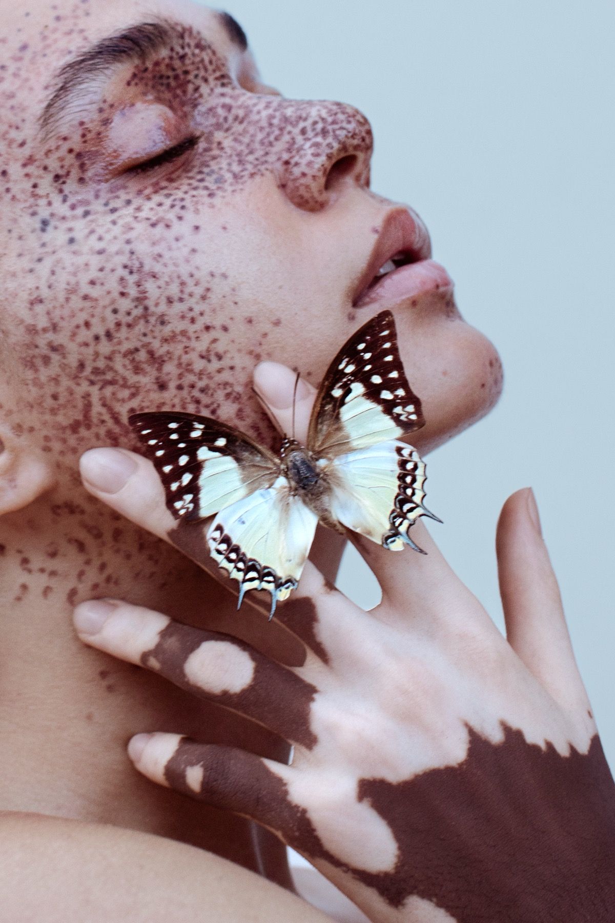 Beauty editorial, freckle-art met vlinder en vitiligo